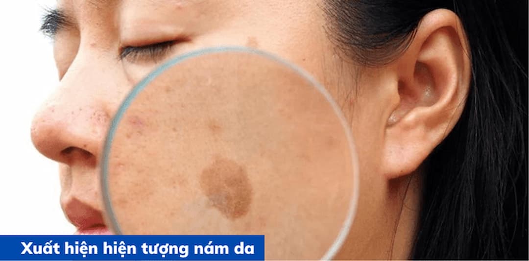 8 nguyên nhân gây nám da phổ biến ở phụ nữ hiện nay