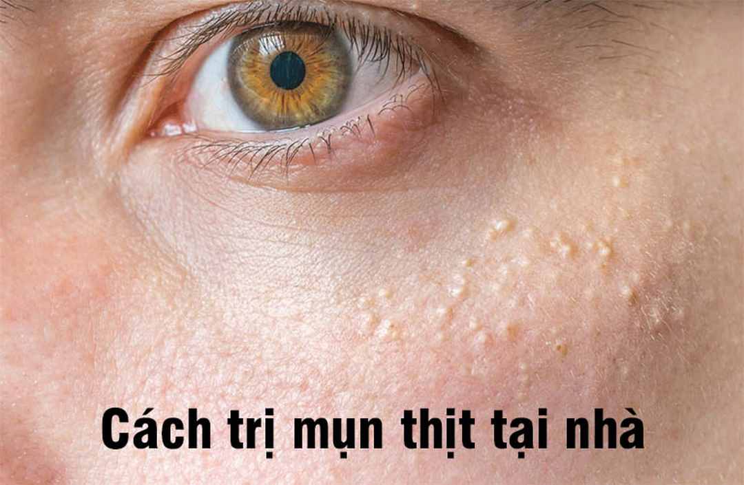 Cách nhận biết mụn thịt